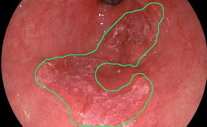 A photo of an esophagus, with the delineation of early cancer as detected by the algorithms of Fons van der Sommen. Credit: TUE