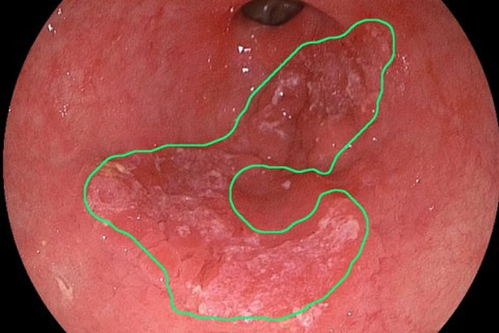 A photo of an esophagus, with the delineation of early cancer as detected by the algorithms of Fons van der Sommen. Credit: TUE