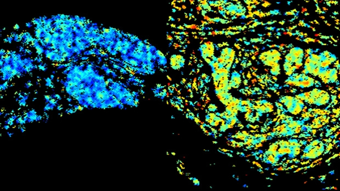 The left image shows a tissue sample with low levels of HER2/HER3 dimers. The right is a sample with high levels (shown by the yellow color). Credit: Professor Tony Ng