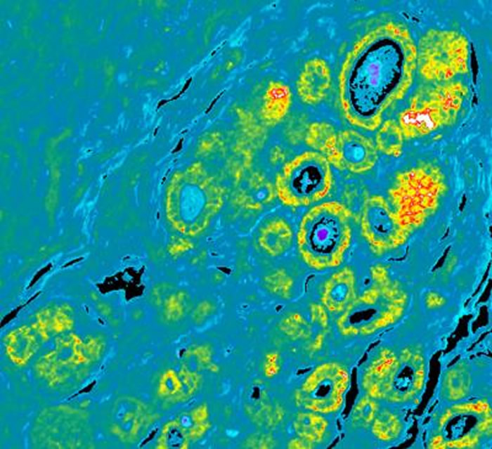 This image shows DCIS sample highlighting aggressive biomarkers. Credit: University of Michigan Health System